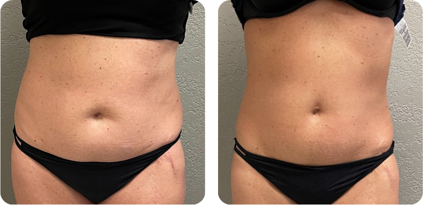 Before and after comparison after 3 fat reduction, 6 muscle conditioning & 8 skin treatments